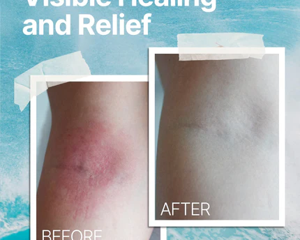 Eczema Soothing Cream – Organic, Hydrating & Fragrance-Free